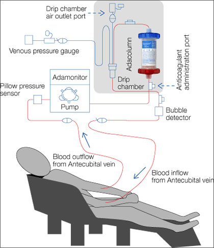 Haemo Dialysis