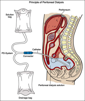 Peritoneal Dialysis