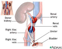 Transplant-Kidney